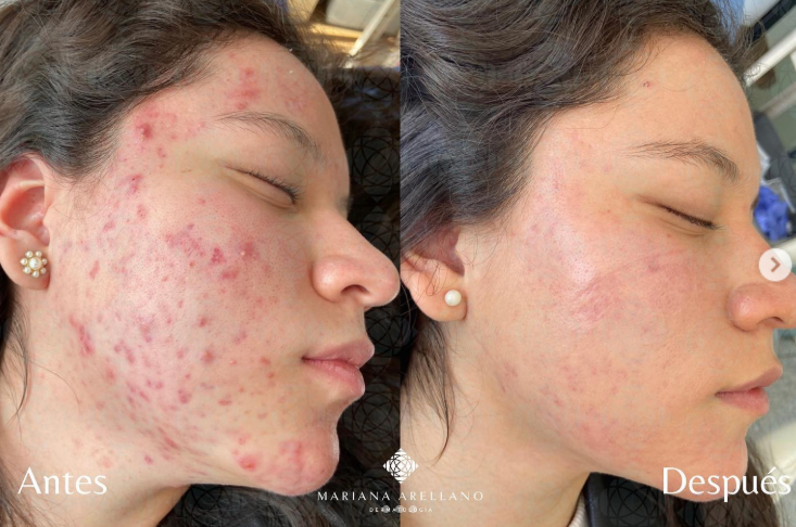  Cebo de res purificado para el cuidado de la piel
Un tratamiento natural que ayuda a mejorar visiblemente el acné gracias a sus propiedades nutritivas y regeneradoras. Su composición rica en ácidos grasos y vitaminas promueve la reparación de la piel, reduce la irritación y favorece una textura más uniforme. Ideal para quienes buscan una alternativa natural y efectiva contra las imperfecciones.